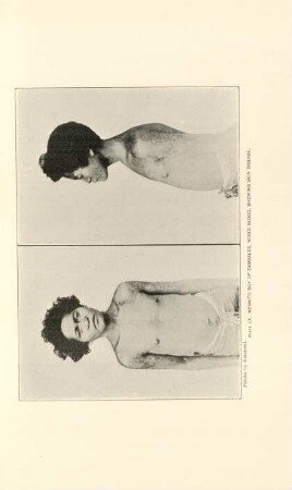 Plate LX. Negrito boy of Zambales, mixed blood, showing skin disease