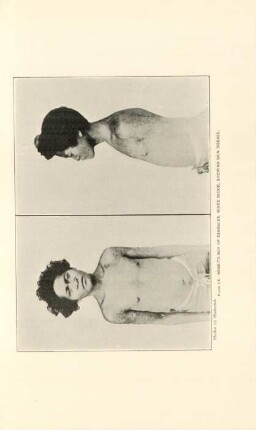 Plate LX. Negrito boy of Zambales, mixed blood, showing skin disease
