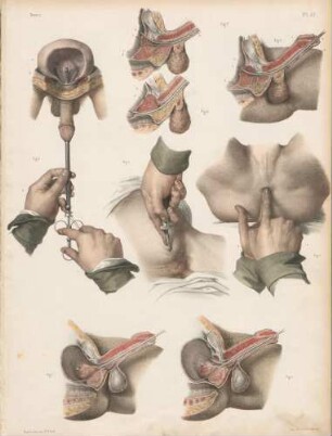 Verschiedene Operationen an der Harnröhre, der Prostata und der Harnblase
