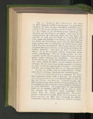 Fig. 77. Sarkom der Aderhaut.