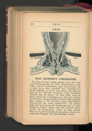 Nicht entzündete Hämorrhoiden.