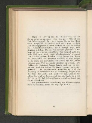 Fig. 22. Atrophie des Sehnervs durch Spannungszunahme des Auges, Glaukom.