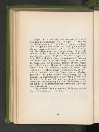 Fig. 22. Atrophie des Sehnervs durch Spannungszunahme des Auges, Glaukom.