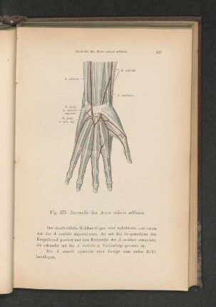 Fig. 575. Anomalie des Arcus volaris sublimis.