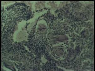 Genitaltuberkulose der Frau