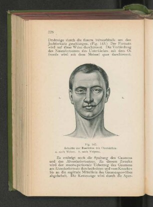 Fig. 142. Schnitte zur Resektion des Oberkiefers.