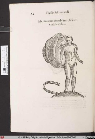 Abortus cum membranis, & vasis umbilicalibus.