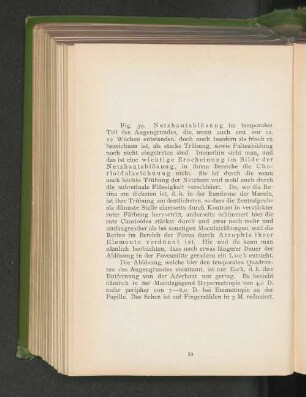 Fig. 59. Netzhautablösung im temporalen Teil des Augengrundes.