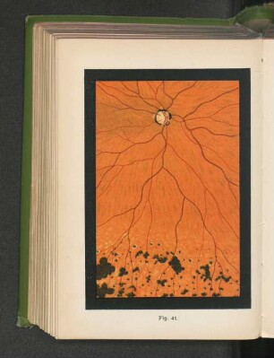 Fig. 41. Veränderung des Augengrundes bei angeborener Syphilis - Typus II.