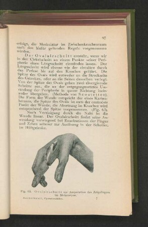 Fig. 63. Ovalairschnitt zur Amputation des Zeigefingers im Metacarpus.