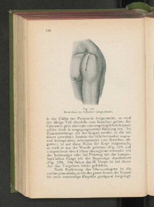 Fig. 118. Resektion der Schulter Längsschnitt.