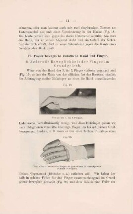IV. Passiv bewegliche künstliche Hand und Finger