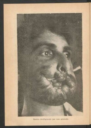 Rostro desfigurado por una granada - [Fotografía]