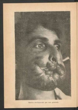 Rostro desfigurado por una granada - [Fotografía]