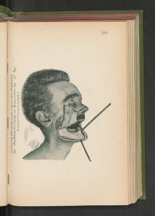 Fig. 145. Unterkieferresektion. Die äußere Fläche des Kiefers ist blossgelegt.