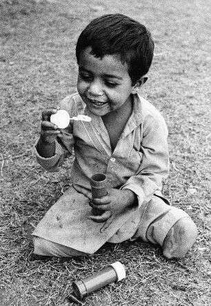 Afghanisches Kind verkrüppelt : Durch eine sowjetische Spielzeugbombe verkrüppeltes afghanisches Kind, aufgenommen 1986 in einem Flüchtlingslager in Pakistan