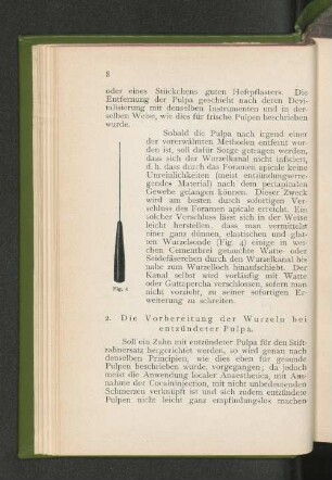 2. Die Vorbereitung der Wurzeln bei entzündeter Pulpa.