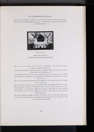 Figur Nr. 333 Hutchinsonsche Zähne, als Zeichen einer angeborenen Syphilis.