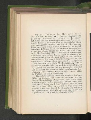Fig. 52. Trübung der Netzhaut durch Stoss oder Schlag aufs Auge, Berlin'sche Trübung, Commotio retinae.