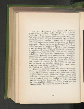 Fig. 52. Trübung der Netzhaut durch Stoss oder Schlag aufs Auge, Berlin'sche Trübung, Commotio retinae.