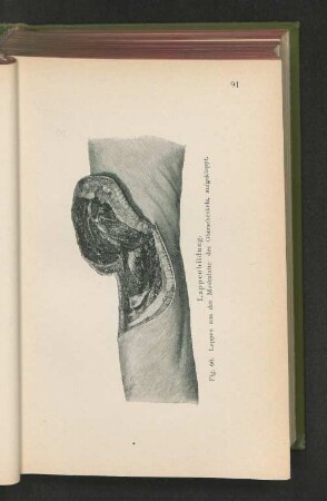 Fig. 60. Lappenbildung. Lappen aus der Muskulatur des Oberschenkels, aufgeklappt.