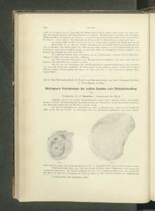 Histologische Veränderungen des lupösen Gewebes nach Röntgenbehandlung.
