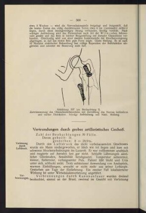 368-374, XII. Verwundungen durch grobes artilleristisches Geschoss.