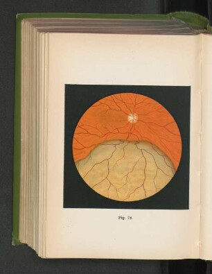 Fig. 78. Sarkom der Aderhaut.