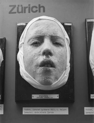 Anatomisches Modell: Kopf einer Jugendlichen mit starkem Pockenbefall