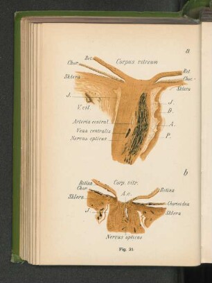 Fig. 21 a. Längsschnitt durch den Sehnerveneintritt bei teilweiser Atrophie des Sehnerven. Fig. 21 b. Längsschnitt durch den Sehnerveneintritt bei totaler Atrophie des Sehnerven.