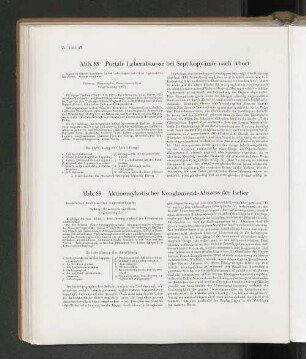 Abb. 89 Aktinomykotischer Konglomerat-Abzess der Leber