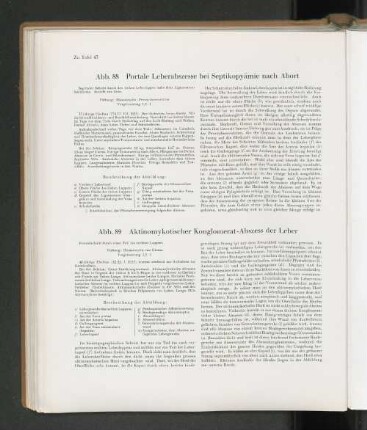 Abb. 89 Aktinomykotischer Konglomerat-Abzess der Leber