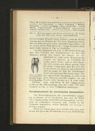 Corrosionsanatomie der pneumatischen Gesichtshöhlen.