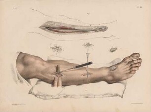 Ligatur an der Arteria tibialis anterior