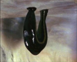Ingestion of Leeches (Hirudinea)