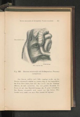 Fig. 325. Recessus retrocaecalis mit freiliegendem Processus vermiformis.