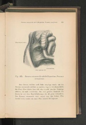 Fig. 325. Recessus retrocaecalis mit freiliegendem Processus vermiformis.