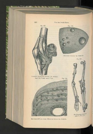 Fig. 128. Gestieltes spongiöses Osteum am unteren Ende des Femurnach Péan.