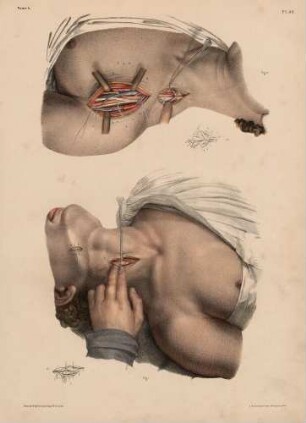 Ligatur der Arteria carotis, subclavia und axillaris