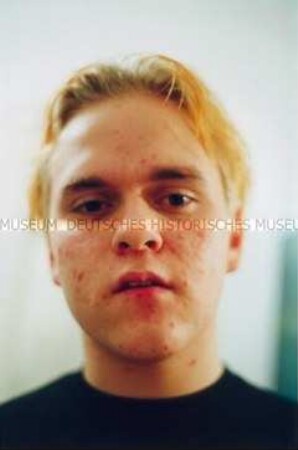 Porträt eines jungen Mannes mit Akne (Altersgruppe 18-21)