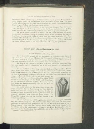 Ein Fall einer seltenen Missbildung der Hand.