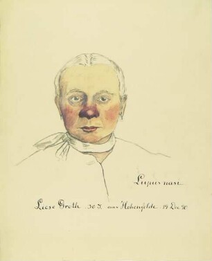 Lupus nasi. Krankenbildnis Liese Groth.
