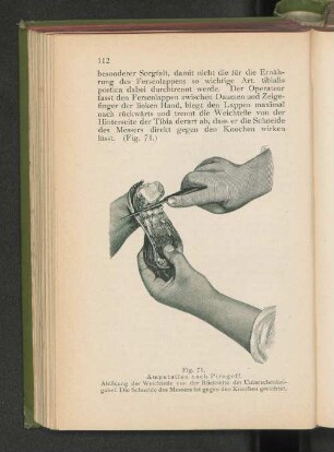 Fig. 71. Amputation nach Pirogoff.
