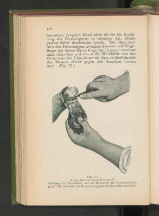 Fig. 71. Amputation nach Pirogoff.