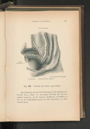 Fig. 339. Varietät des Colon sigmoideum.
