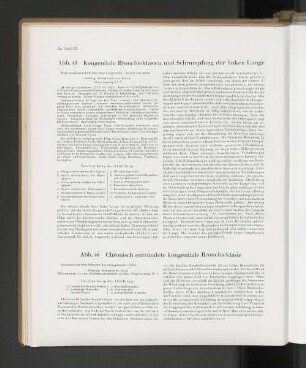 Abb. 45 Kongenitale Bronchiektasien und Schrumpfung der Linken Lunge