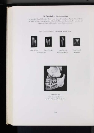 Die Zahnfäule - Keires dentium