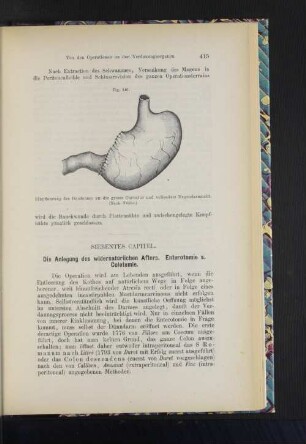 Siebentes Capitel. Die Anlegung des widernatürlichen Afters. Enterotomie s. Colotomie.