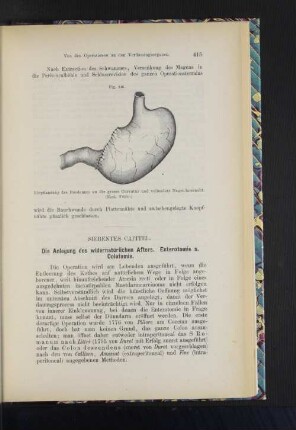 Siebentes Capitel. Die Anlegung des widernatürlichen Afters. Enterotomie s. Colotomie.