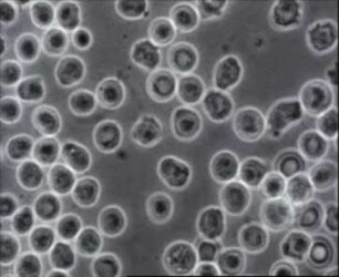Dynamics of Leukemia Cells